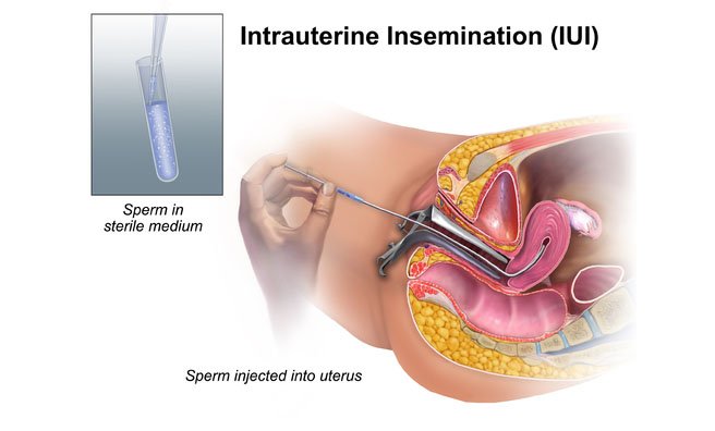 IUI (Intrauterine Insemination)